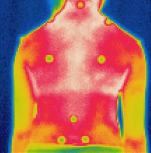 非脊柱侧弯的受试者的红外图像-沿脊柱旁肌肉的对称温度分布(1)